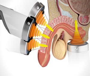 focused shockwave therapy for ed at home scaled 1